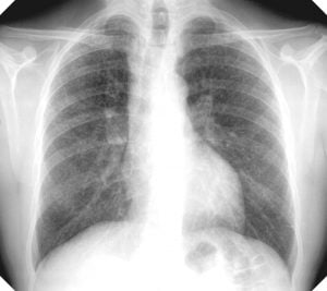 an x-ray showing the lungs being affected with Silicosis